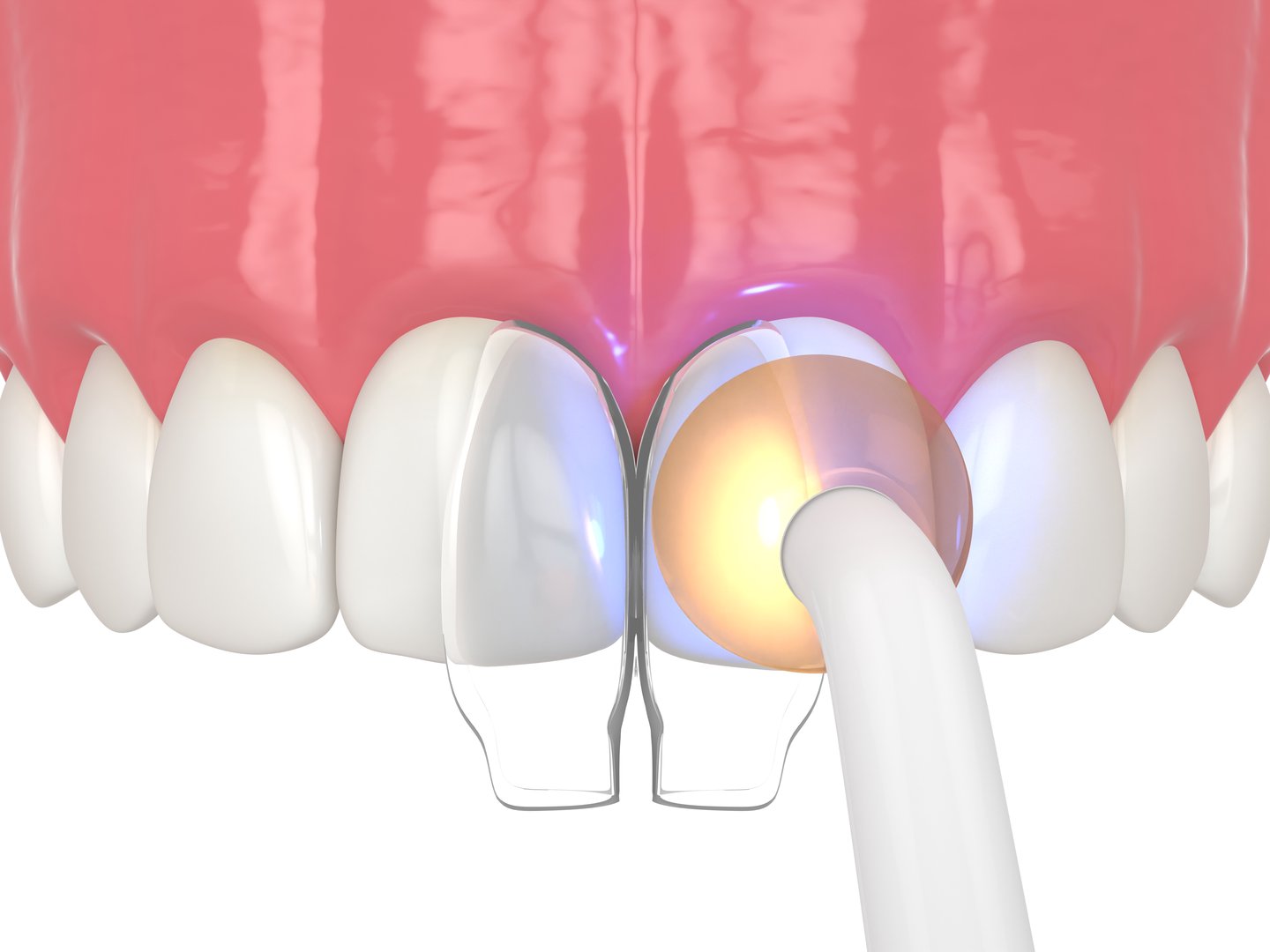 Cosmetic Dental Bonding Near Me in Asheville, NC
