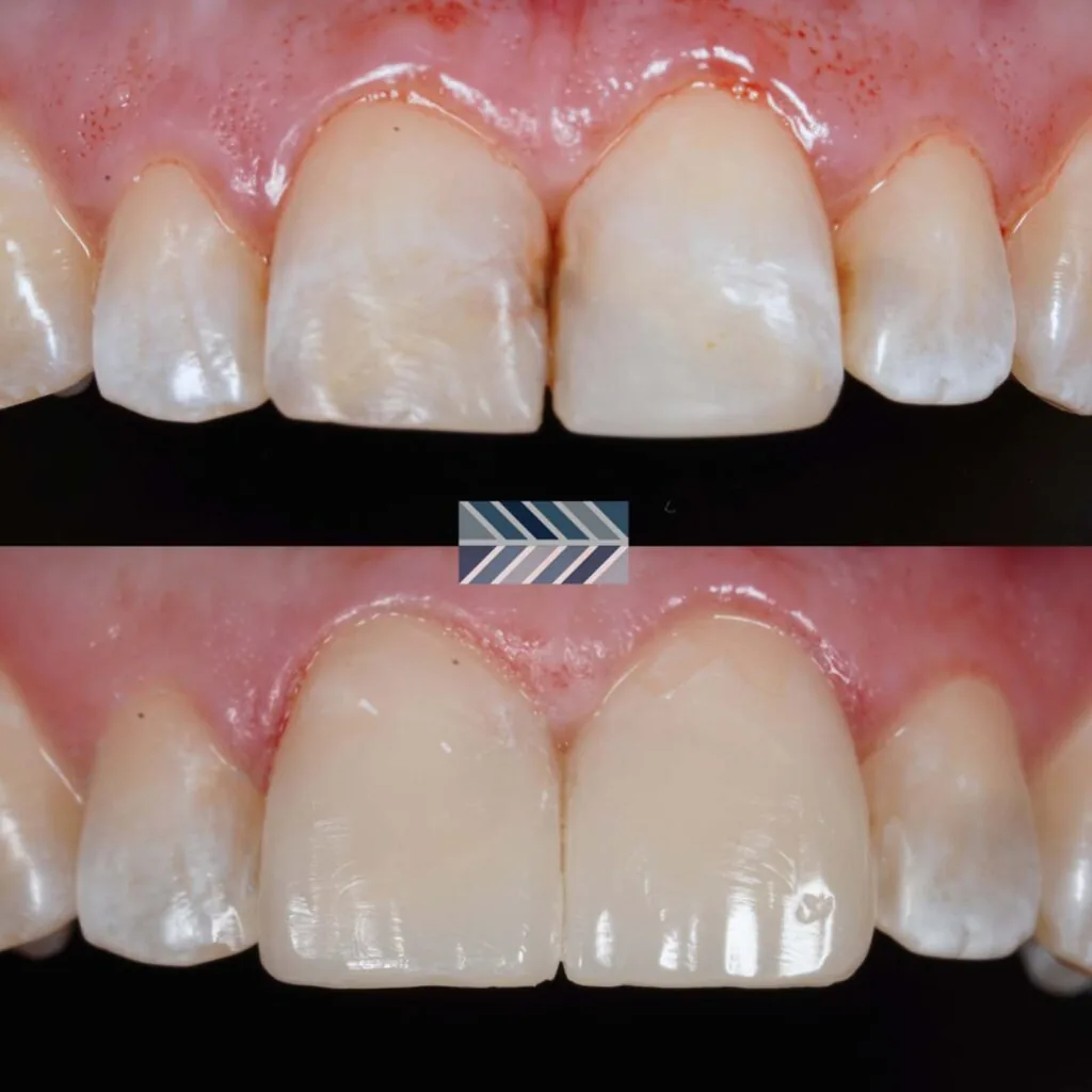 Composite-Veneers-1024x1024.jpg