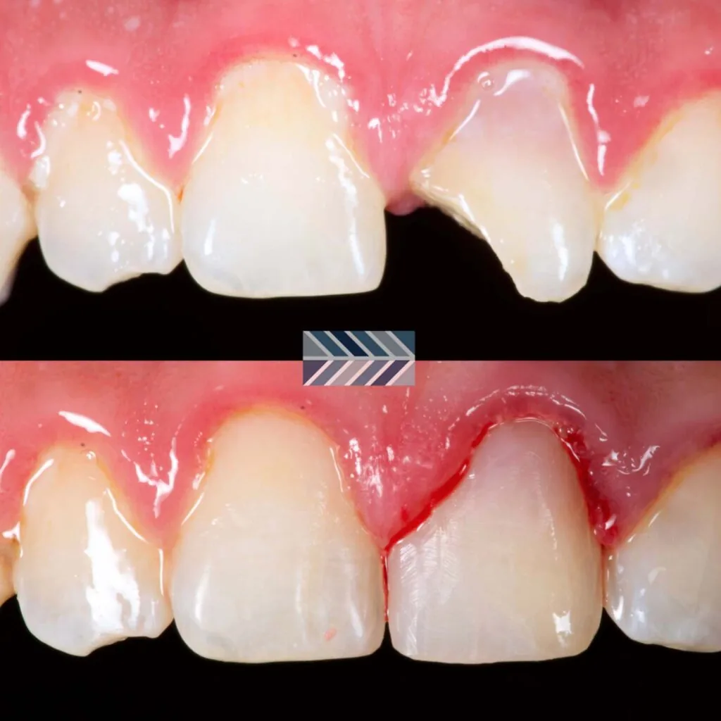 Dental-Trauma-Class-IV-Case-2-1024x1024.jpg