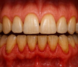 Mouth with moderate periodontal disease