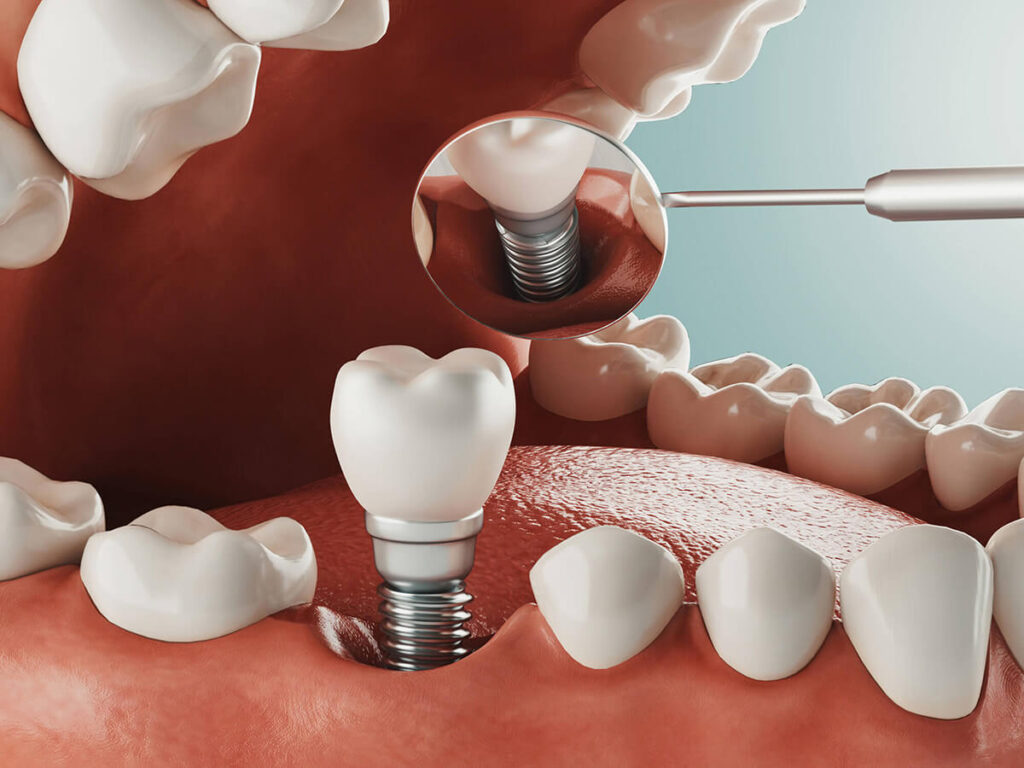 dental implants