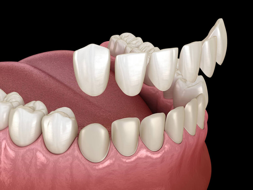 dental veneers 3d rendering