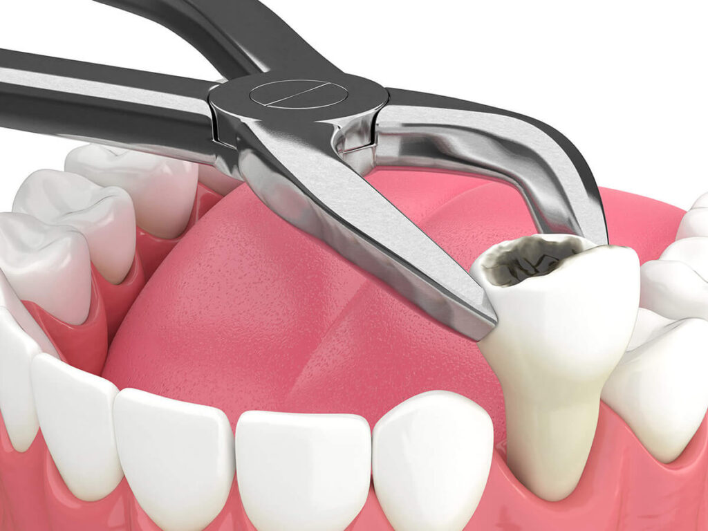 3d rendering of tooth extraction