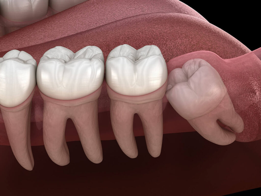 widsom tooth 3d rendering